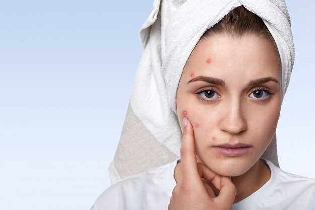 Что такое купероз на лице и как с ним бороться?
